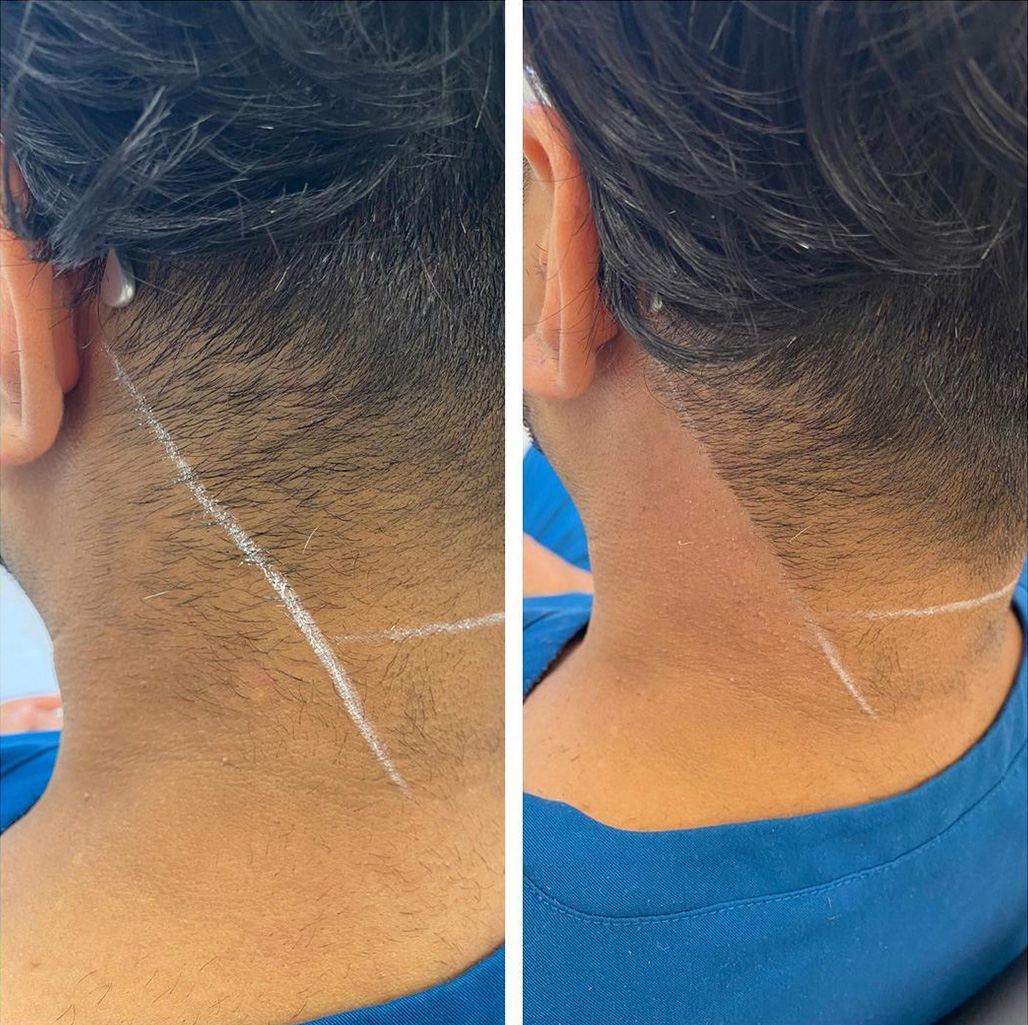 Hair Removal Hair Removal