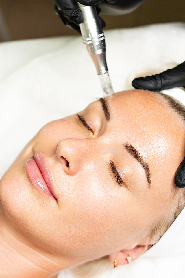 Microneedling