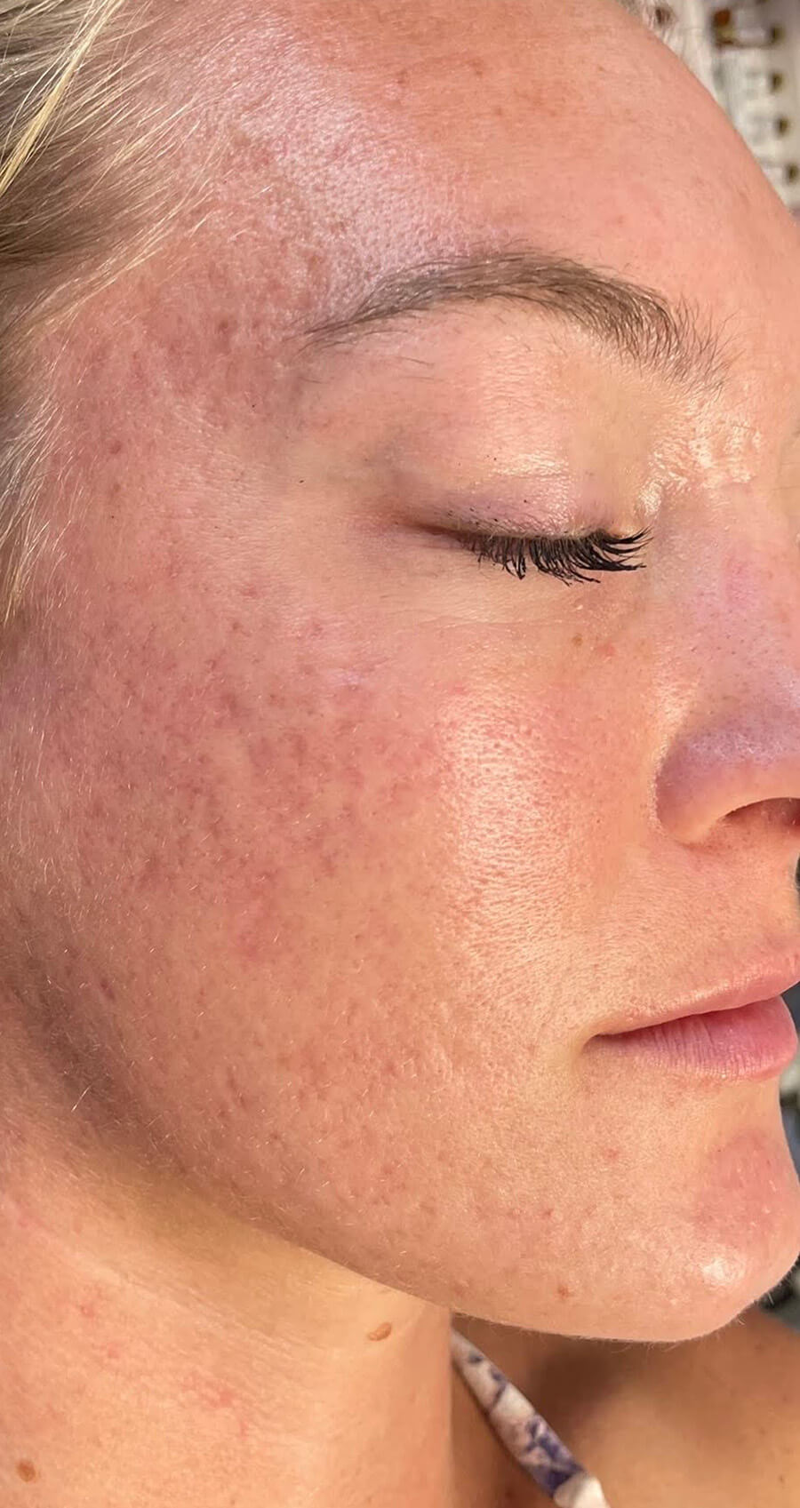 Microneedling - After