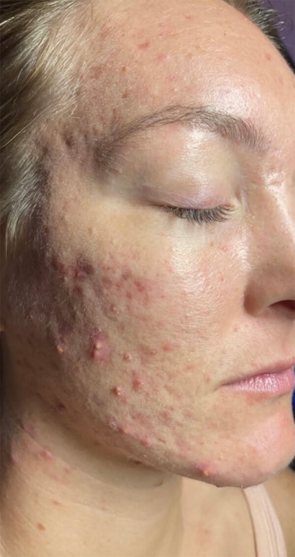 Microneedling - Before