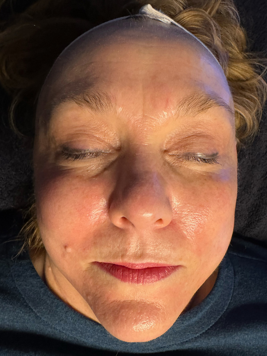 After Hydrafacial™