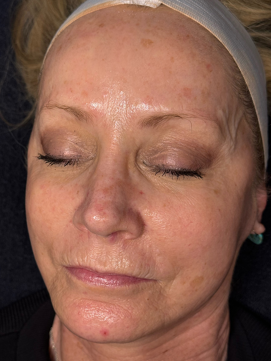 After Hydrafacial™