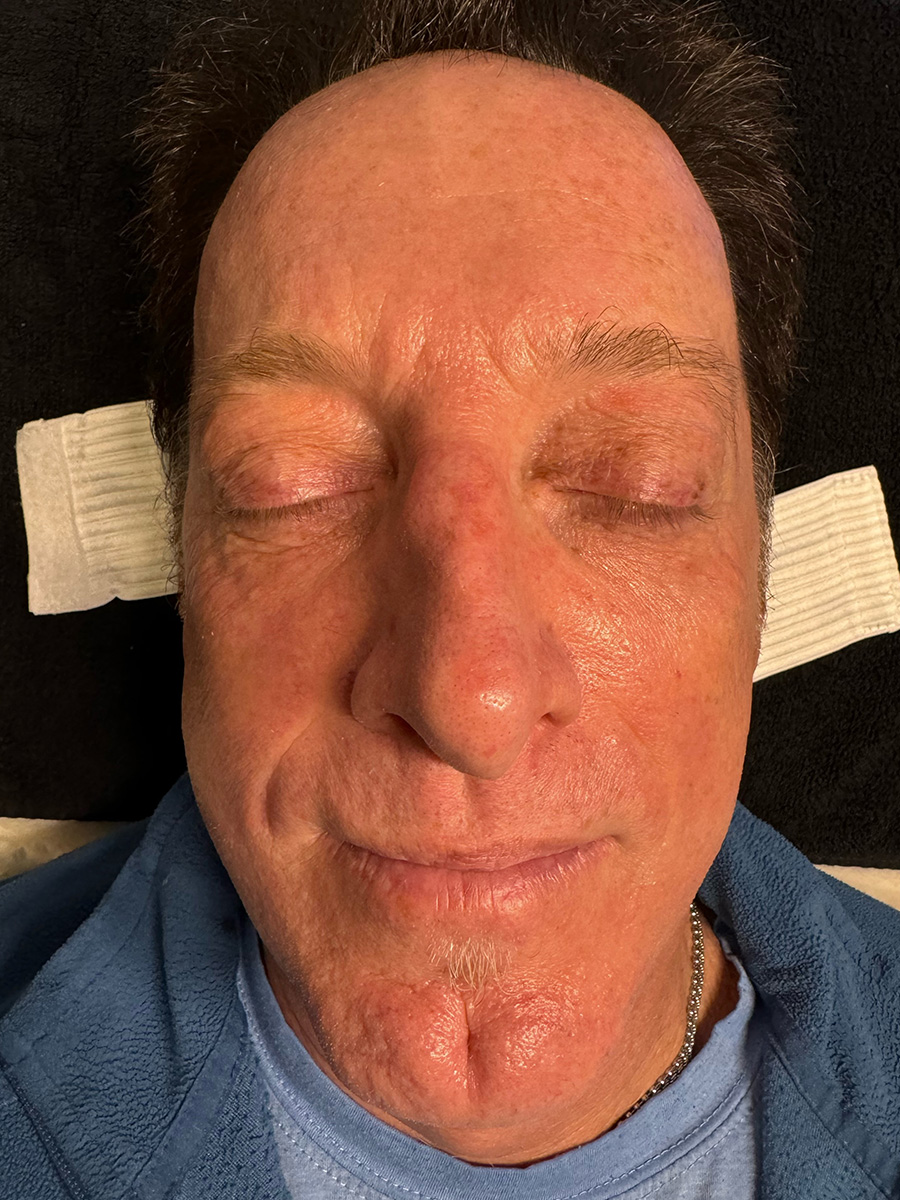 After Hydrafacial™